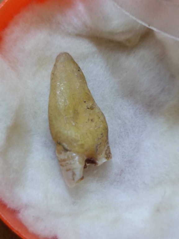 พระทันตธาตุครูบาอุ่นคำ วัดผาสุการาม จ.เชียงราย เจ้าของเดิมชื่อลุงสงวน เคยเป็นคนขับรถและเป็นศิษย์ใกล้ชิดหลวงพ่อตี๋ วัดพรหมวิหาร เคยรับใช้และสะสมวัตถุมงคลของครูบาอุ่นคำ ลุงสงวนอยู่บ้านป่าเหมือด อ.แม่สาย เสียชีวิตเมื่อวันที่ 9 มีนาคม 2558 อายุ 78 ปี