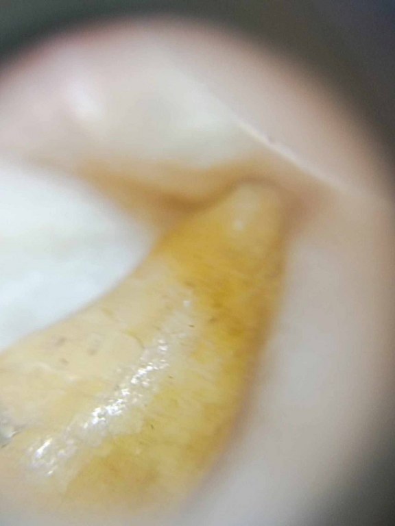 พระทันตธาตุครูบาอุ่นคำ วัดผาสุการาม จ.เชียงราย เจ้าของเดิมชื่อลุงสงวน เคยเป็นคนขับรถและเป็นศิษย์ใกล้ชิดหลวงพ่อตี๋ วัดพรหมวิหาร เคยรับใช้และสะสมวัตถุมงคลของครูบาอุ่นคำ ลุงสงวนอยู่บ้านป่าเหมือด อ.แม่สาย เสียชีวิตเมื่อวันที่ 9 มีนาคม 2558 อายุ 78 ปี