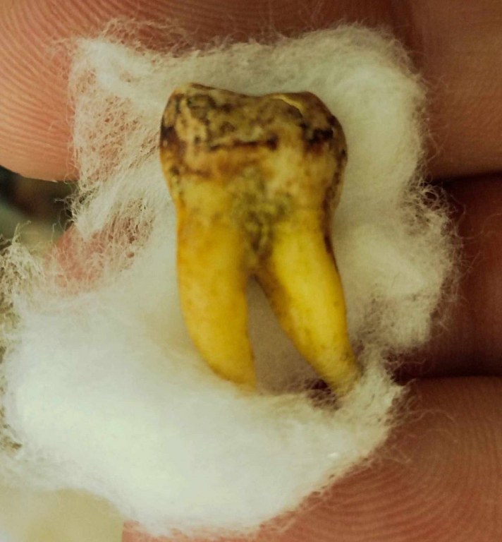 พระทันตธาตุครูบาคำแสน วัดป่าดอนมูล จ.เชียงใหม่ ได้มาจากกำนันคำ อดีตกำนันบ้านปากกอง อ.สารภี จ.เชียงใหม่ ปัจจุบันอายุ 86 ปี กำนันคำจะมีคนคอยหาวัตถุมงคลให้ ชื่อว่าลุงสมควร ปัจจุบันเสียชีวิตแล้ว ถ้ามีชีวิตอยู่ถึงปัจจุบันน่าจะมีอายุประมาณ 70 ปี