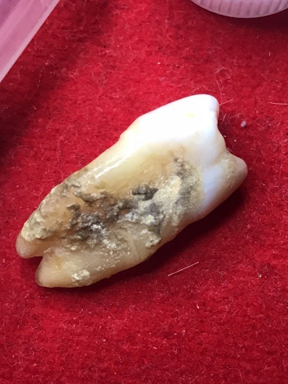 พระทันตธาตุ ครูบาติ๊บ วัดท่าวังพร้าว อ.สันป่าตอง จ.เชียงใหม่ ได้มาจากกำนันคำ อดีตกำนันบ้านปากกอง อ.สารภี จ.เชียงใหม่ ปัจจุบันอายุ 86 ปี (บันทึก พ.ศ.2566) กำนันคำได้พระทันตธาตุครูบาติ๊บ ได้มาเมื่อปี พ.ศ.2549 ได้มาจากลูกศิษย์ครูบาติ๊บ ชื่อลุงวิโรจน์