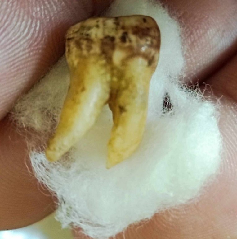 พระทันตธาตุครูบาคำแสน วัดป่าดอนมูล จ.เชียงใหม่ ได้มาจากกำนันคำ อดีตกำนันบ้านปากกอง อ.สารภี จ.เชียงใหม่ ปัจจุบันอายุ 86 ปี กำนันคำจะมีคนคอยหาวัตถุมงคลให้ ชื่อว่าลุงสมควร ปัจจุบันเสียชีวิตแล้ว ถ้ามีชีวิตอยู่ถึงปัจจุบันน่าจะมีอายุประมาณ 70 ปี