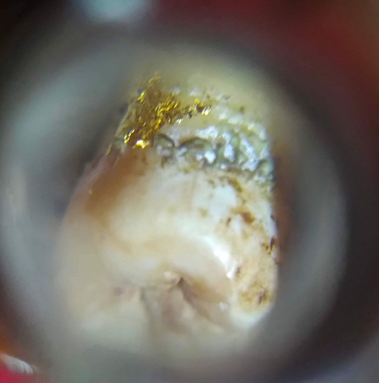 พระทันตธาตุ ครูบาสิทธิ วัดปางต้นเดื่อ อ.แม่อาย จ.เชียงใหม่ เจ้าของเดิมชื่อคุณบอม เคยเป็นเภสัชโรงพยาบาลสันทราย จ.เชียงใหม่ ปัจจุบันอายุ 47 ปี (บันทึก พ.ศ.2566) เคยเป็นศิษย์และนับถือครูบาสิทธิตั้งแต่ปี 2549 - 2555 จนครูบาสิทธิท่านมรณภาพ