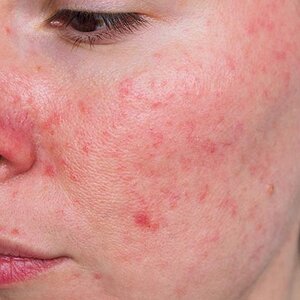 Rosacea เป็นภาวะที่พบได้บ่อยในผู้หญิงมากกว่าผู้ชาย
